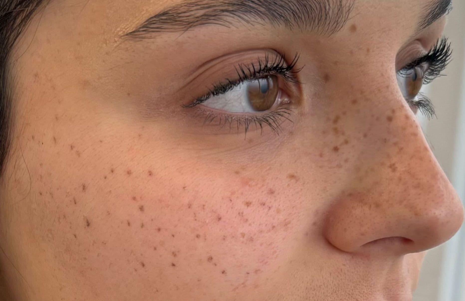 Application de tatouage permanent de taches de rousseur sur la joue et la tempe, rendu doux et hyper réaliste sur peau claire, expertise Habiba Med.