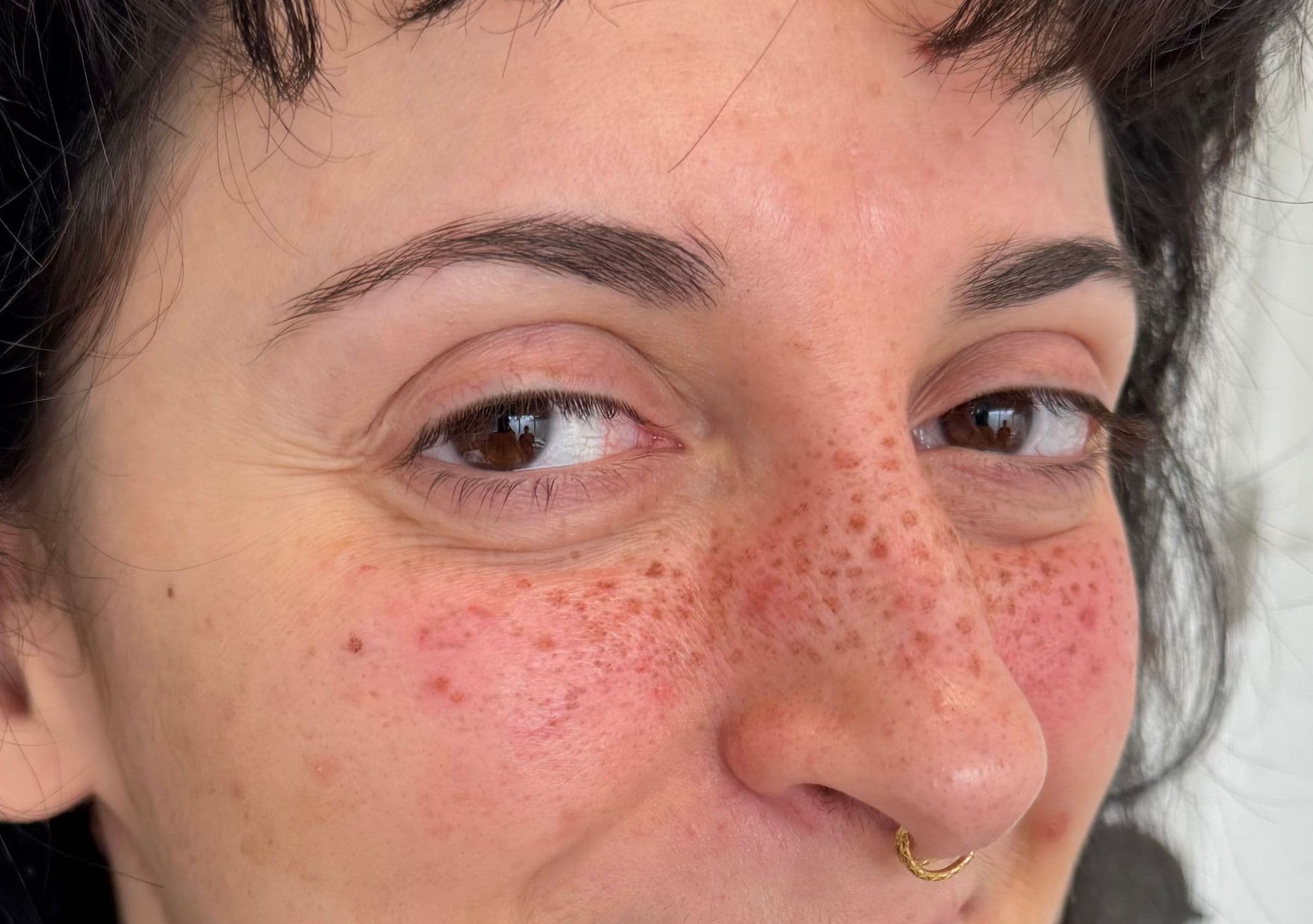 Tatouage des taches de rousseur permanent avec effet coup de soleil sur peau claire, pigmentation esthétique visage pour un fini frais et lumineux.